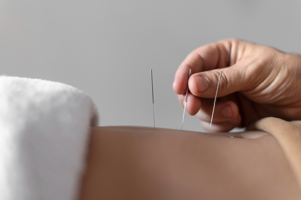 can acupuncture weight loss