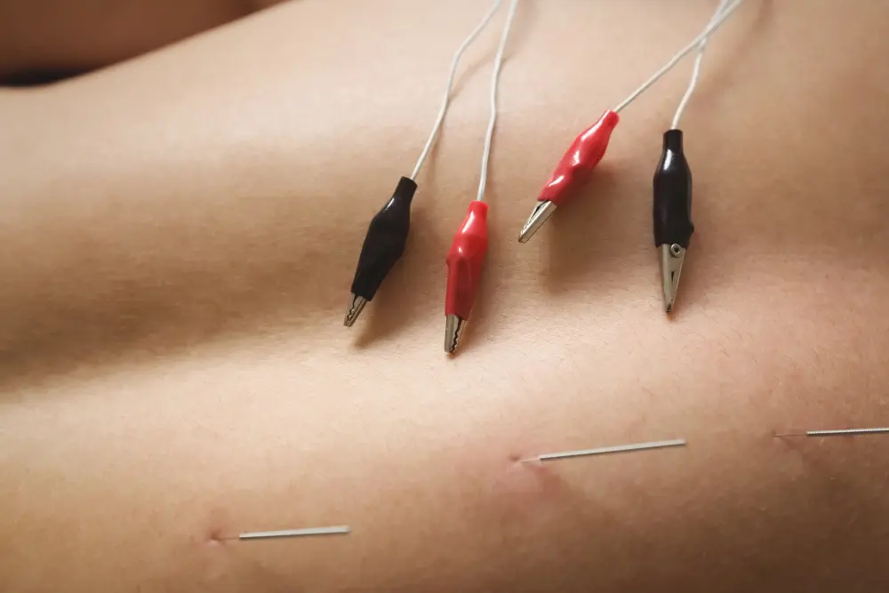 Acupuncture Relieve Pain According to Chinese Medicine