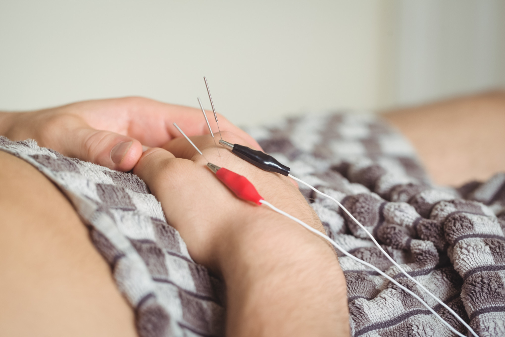 Can Acupuncture Help Neuropathy? Benefits and What to Expect