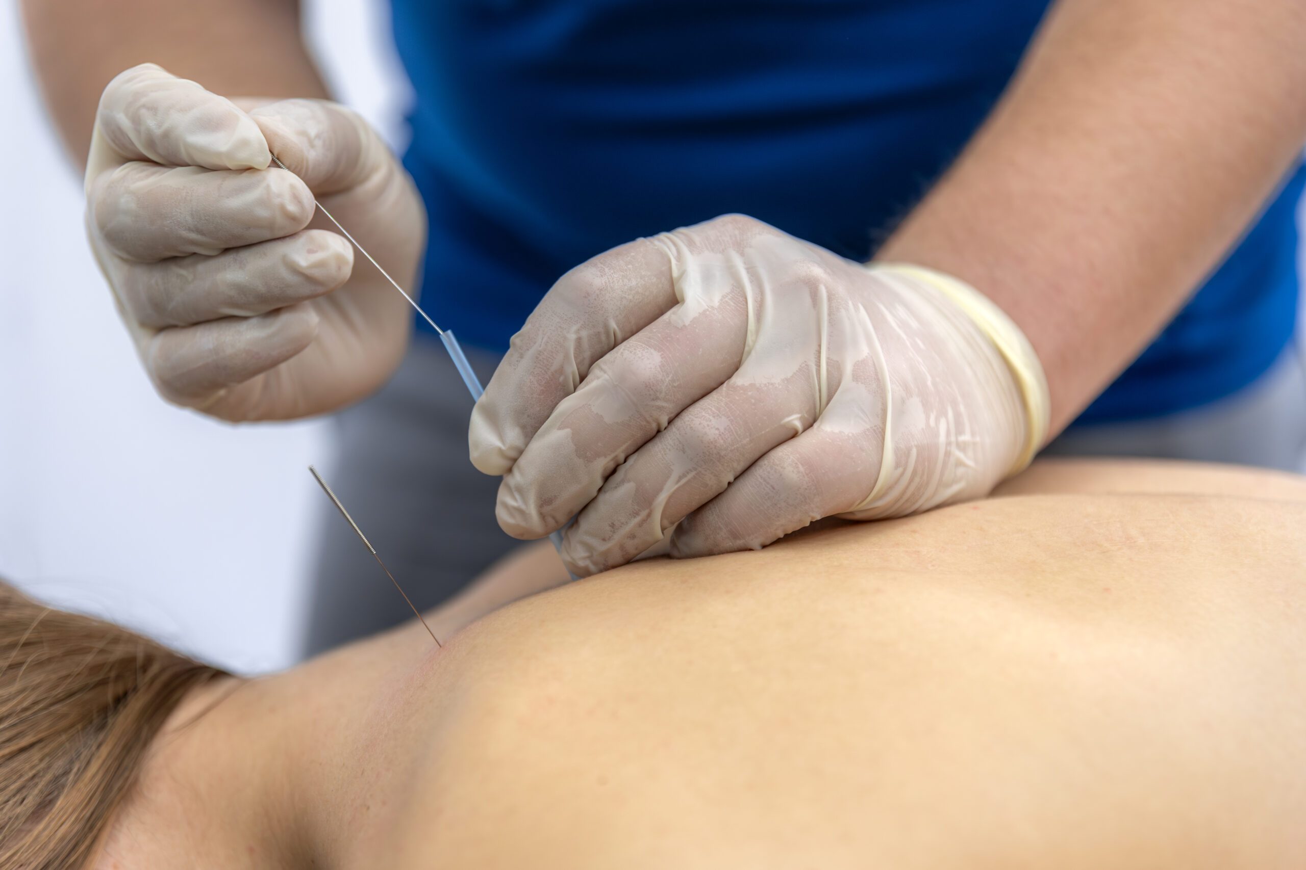 Best Acupuncture Clinic in Manhattan: