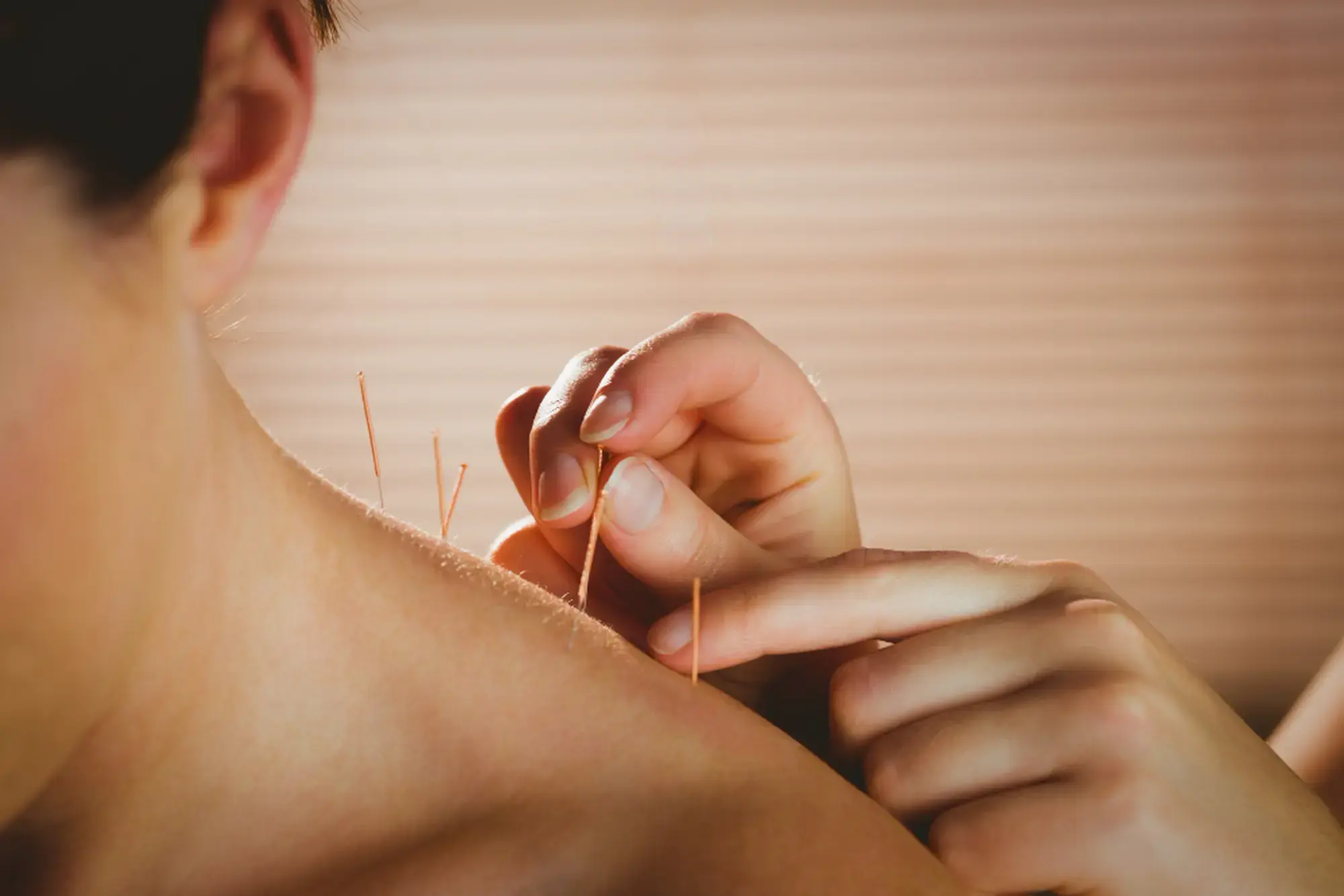 Acupuncture for anxiety insomnia